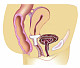 Gellhorn-pessary-inserted_2.jpg